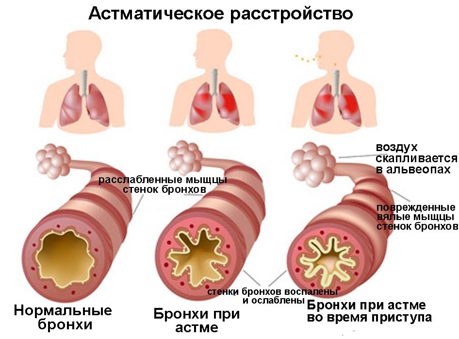Asthmatic-disorder