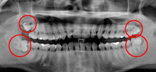 betændelse i tandkødet omkring visdom tand behandling