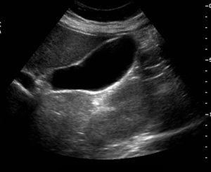 Funktionel diarré: symptomer, behandling, ICD-10-kode