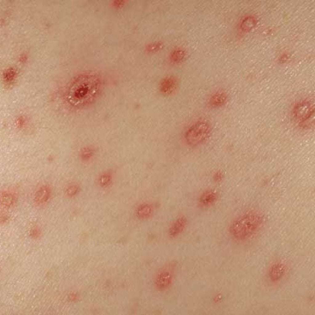 Echinococcus: symptoms in humans, photos, causes and treatment of echinococcosis