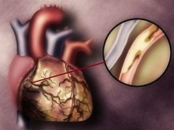 Aterosklerotisk hjertesygdom