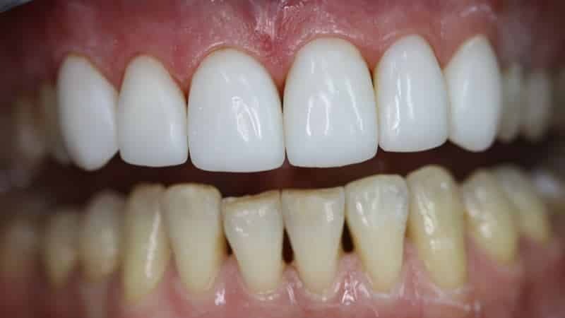 Was passiert, wenn die nackten Wurzeln der Zähne gelegt - Ihre Zähne