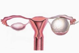 Un kyste de l'ovaire chez une femme