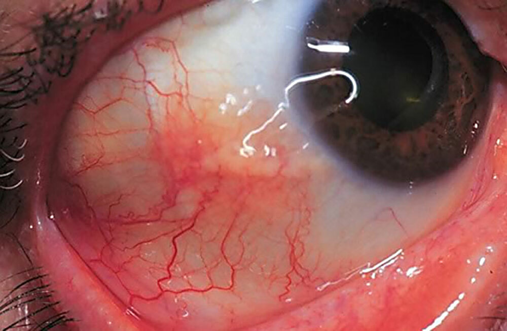 lesão dos olhos: sintomas e tratamento