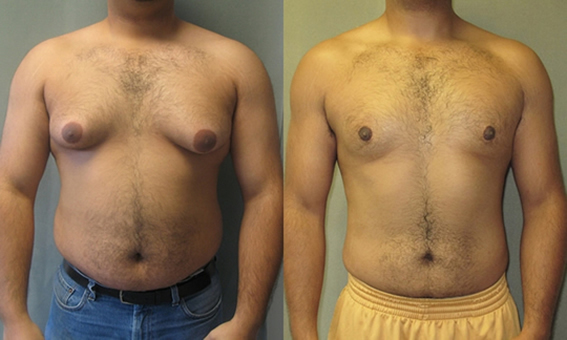 Gynecomastia - before and after surgery