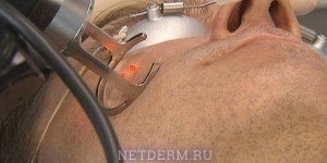 Uklanjanje ožiljaka laserom