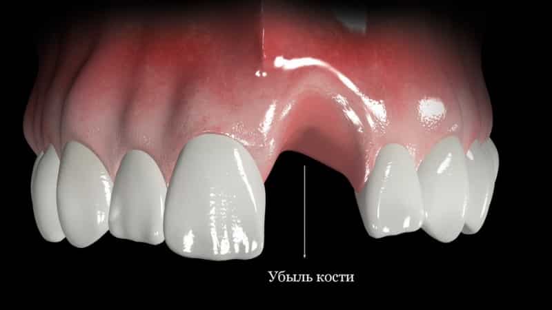 Through what after removal of a tooth time it is possible to put an implant
