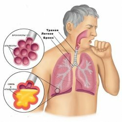 Streptococcal pneumonia