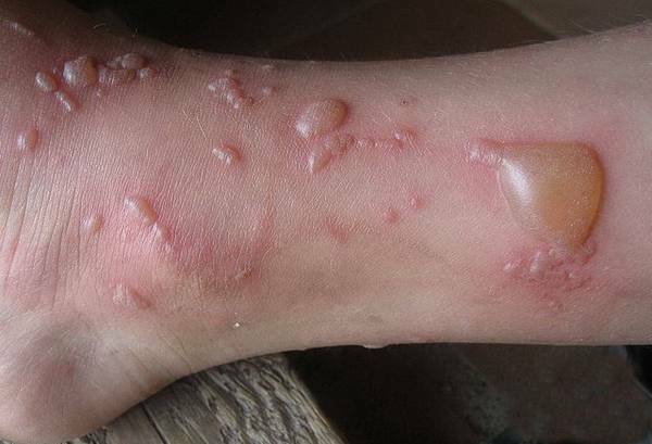 Symptomen van bulleuze dermatitis