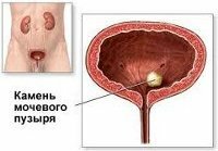 Concrements in the bladder in the second stage of BPH