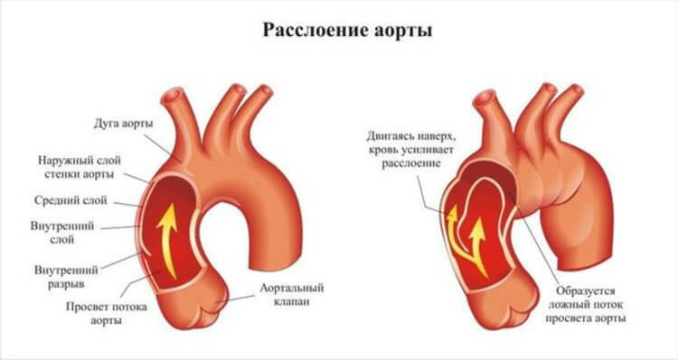 Aneurysm of the aorta: symptoms, treatment, prevention