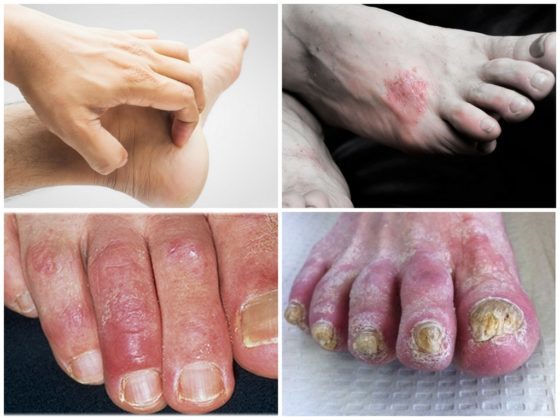 O fungo do pé: tipos, causas, sintomas, tratamento, fotos