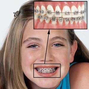 Metal-braces-kharkov-dentist
