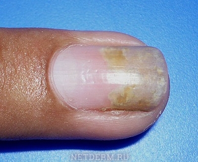 Varianter av psoriasis av naglar