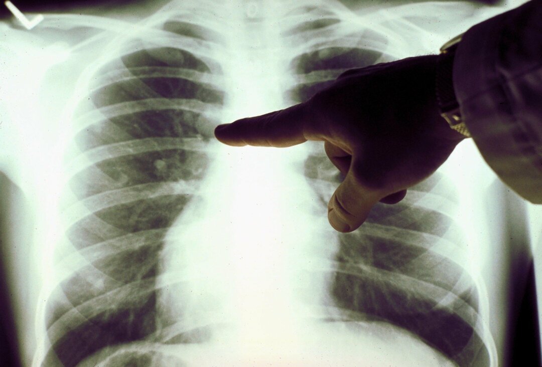 Dijagnoza raka pluća