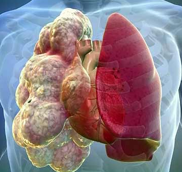 Emphysema of the lung: symptoms and treatment