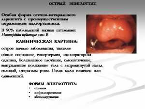 Epiglottite