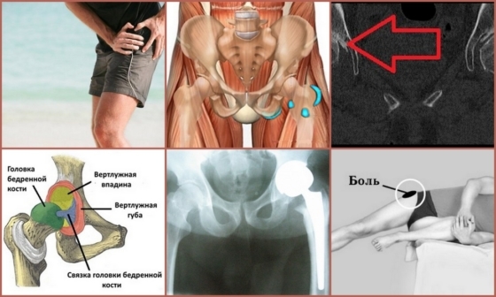 Maladie de la hanche: symptômes, photo, traitement (exercice, injections, comprimés, pommades, types de transactions)
