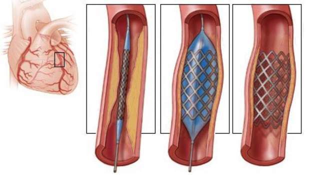 Ангиопластика коронарних артерија и поступак скенирања