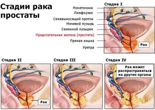 Stadiality del cáncer de próstata: etapas del desarrollo de la enfermedad y pronóstico