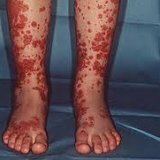 Allergiás vérzéses vasculitis, Shenlaine Henoch-kór