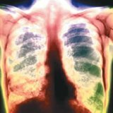 Tuberkulóza u dětí: formy, symptomy, léčba