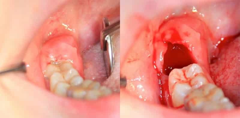 Alveolit ​​efter tandutdragning: foto, behandling, torrt hål