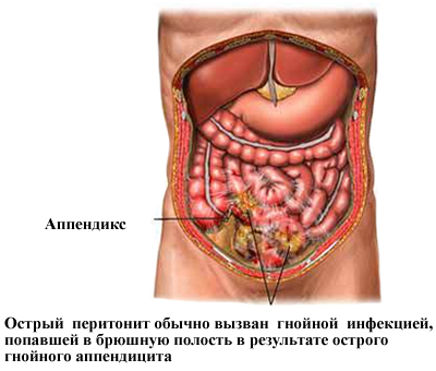 Oorzaken van peritonitis