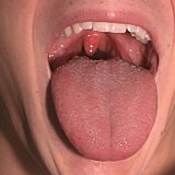 Burns of the oral mucosa