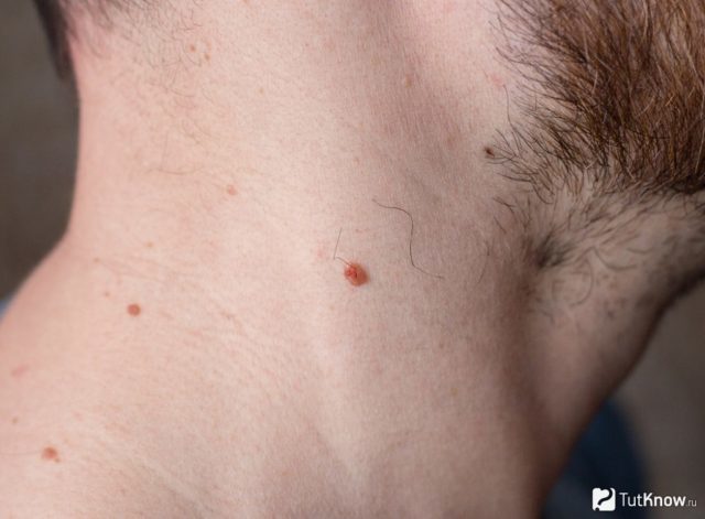 Why do papillomas appear on the neck in men