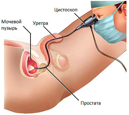 How is bladder cystoscopy performed in men?