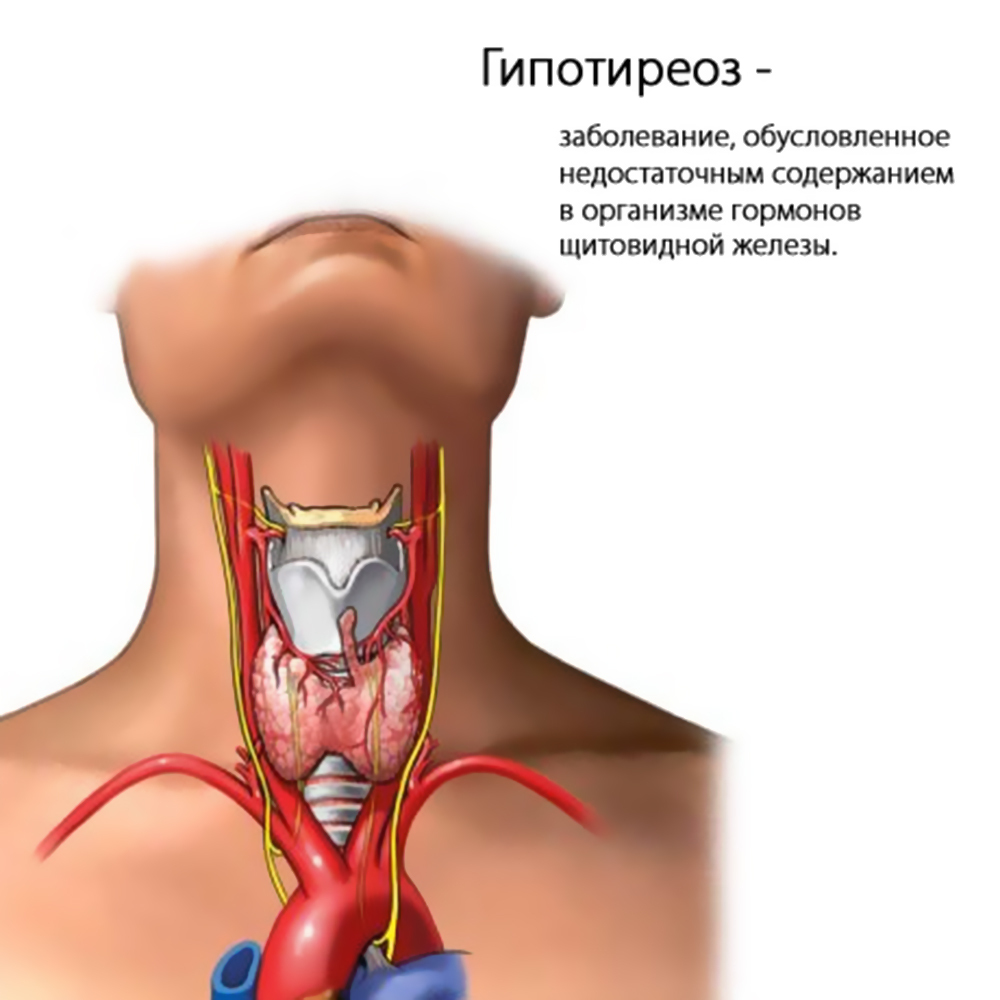Diagnosis of thyroid hypothyroidism