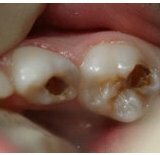 Treatment of pulpitis of infant teeth