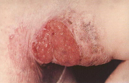 Tuberkuloza kožne fotografije ulkusnog oblika