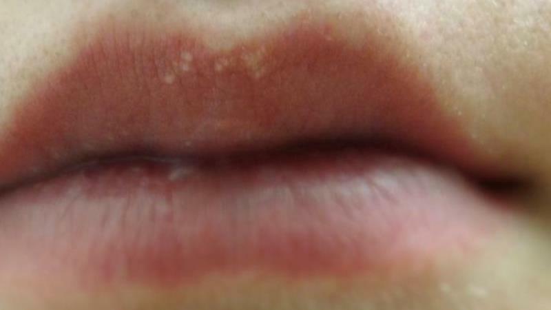 warum weißen Flecke erscheinen auf den Lippen