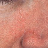 Symptoms and treatment of seborrheic dermatitis