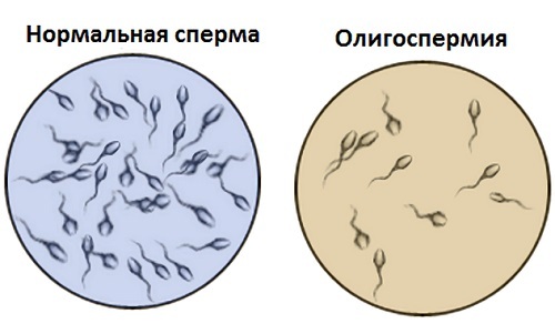 oligospermija