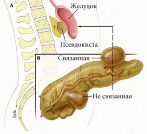 Sekwestratiestadium van pancreatitis