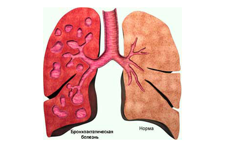 bronchiëctasie disease