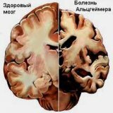 Je li Alzheimerova bolest iznenada?