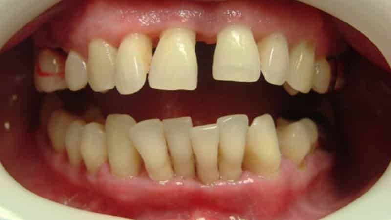 Till skillnad från parodontit av tandlossning