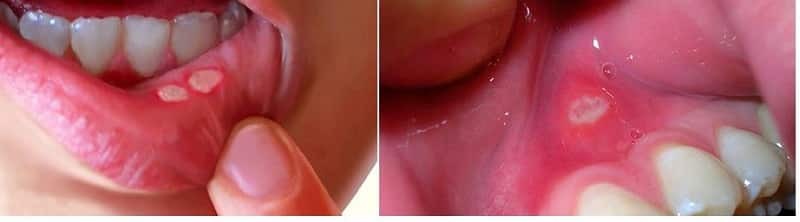 Można uzyskać z jamy ustnej dziecka