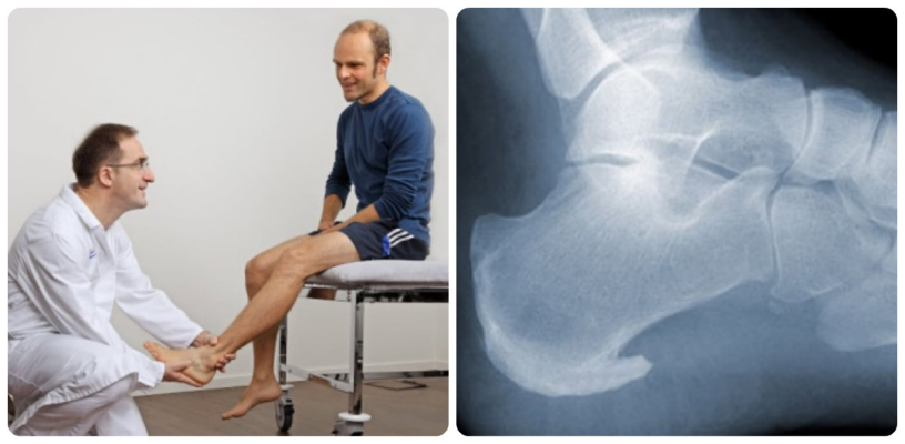 Palpation et rayons X du pied - des procédures contraignantes pour le diagnostic des éperons talon