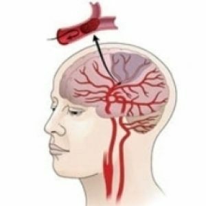 Hemorragisk stroke: behandling konsekvenser och prognoser
