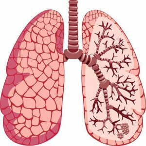 Scheme-atelectasis-lung