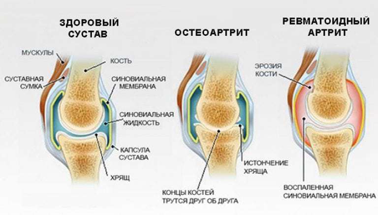 Arthritis and rheumatic diseases: types, causes, symptoms, treatments