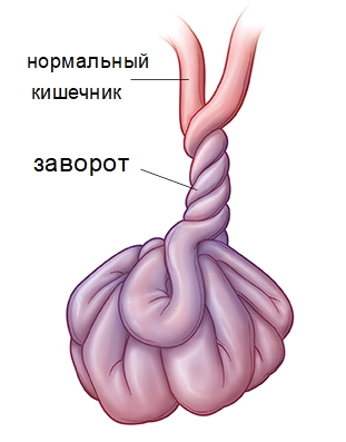 Volvulus op het diagram