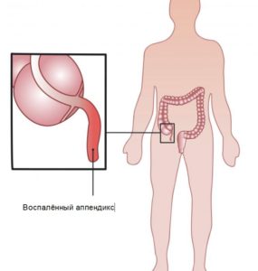  Appendiks inde i menneskekroppen