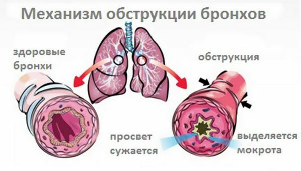 Causes of obstructive bronchitis