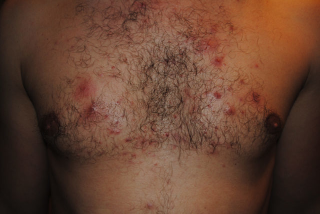Causes and treatment of acne on the body of men